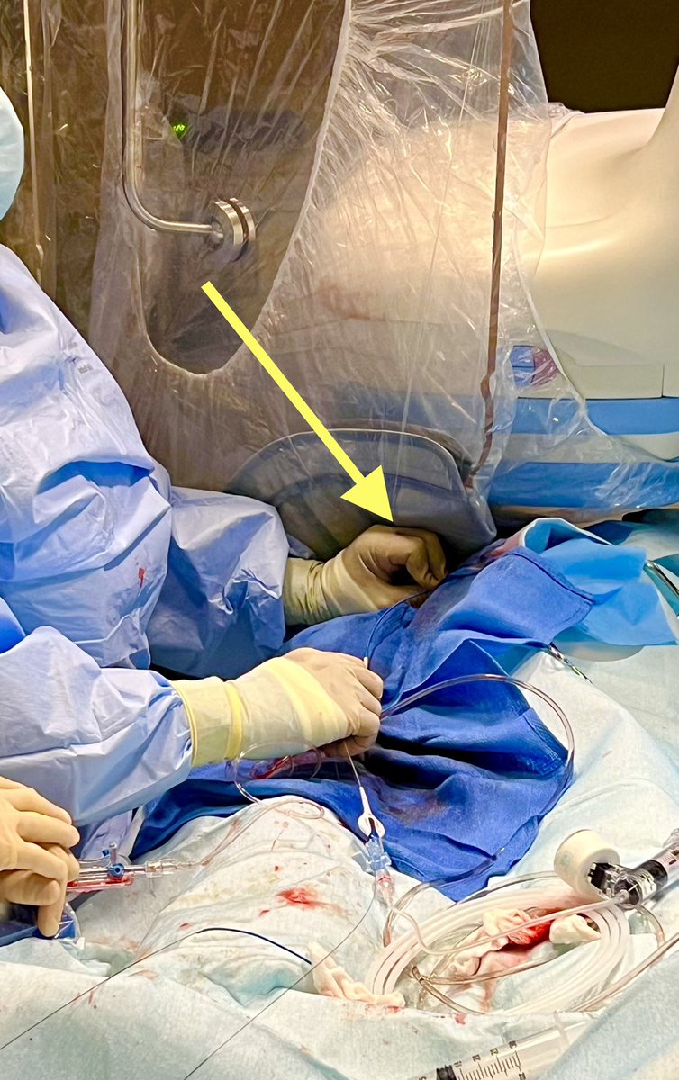 Tesslagra's tweet image. Little #cathlabhack for caudal views from LRA approach. 
Tuck the lead skirt just over the hub of the sheath. This will limit scatter☢️ to the 🤚 &amp;amp; still provide great protection to the upper body with ceiling mounted shield. Done with peekaboo technique preserving ergonomics