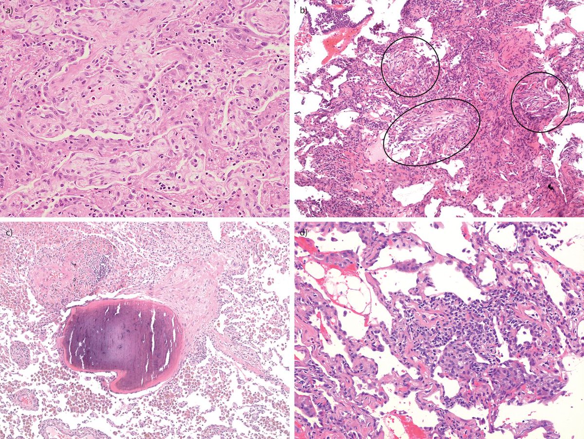 ERSpublications's tweet photo. Interstitial lung disease is a potentially severe and even fatal adverse drug reaction. The number of culprit drugs continues to increase. Identification and discontinuation of the causative drug is the cornerstone of treatment. https://t.co/F6yjVro5p8 https://t.co/H0t8Y9Kp5V