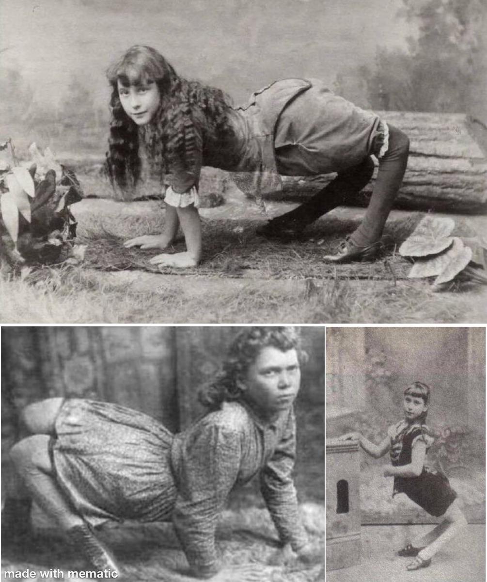 La femme apparaissait sur cette image s'appelait Ella Harper. 

Elle était atteinte d'une sévère forme de "genu recurvatum", une malformation de l'articulation du genou qui entraîne une hyperextension du genou vers l'arrière. 

Bien plus à l'aise à quatre pattes, elle se