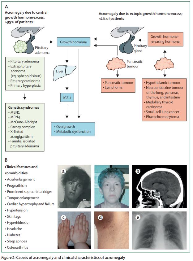 Today is World Acromegaly Awareness Day 2022. Read: Acromegaly: pathogenesis, diagnosis, and management thelancet.com/journals/landi… #Acromegaly #pituitary #FREE to read with registration (also FREE) until 7th November