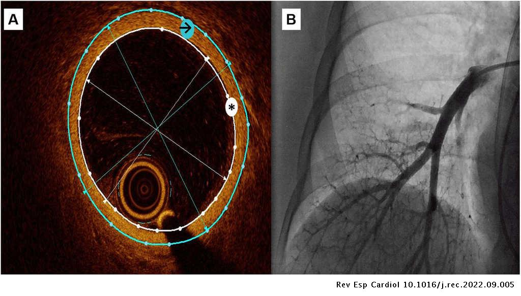 Correlation between intimal thickness assessed with OCT and pulmonary hypertension #REC #AheadOfPrint @Carlos_Ortiz85 @egutiMD @frenandosarnago @Beadimo @isaacpascual79 @mgomezbueno @SantosCalvino @GomezHospital @juangdelara revespcardiol.org//en-optical-co…