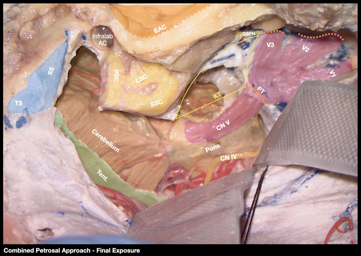 Edoardo Porto, MD (@edoardoporto) on Twitter photo Getting ready for the <a href="/EmoryUniversity/">Emory University</a> Cranial Base Surgery Course “A 360 Degree Perspective” Hands-On Workshop - Nov 3-5! Do not miss the opportunity to join! <a href="/gpradil2/">Gustavo Pradilla</a> <a href="/GarzonMuvdi/">Tomas Garzon-Muvdi</a> <a href="/ManuRevuelta/">Manu Revuelta, MD, PhD</a> <a href="/alerodas23/">Alejandra Rodas, MD</a> <a href="/justmaldo/">justmaldo</a> <a href="/EmorySkullBase/">Emory Skull Base Surgery</a>
med.emory.edu/departments/ne… Getting ready for the <a href="/EmoryUniversity/">Emory University</a> Cranial Base Surgery Course “A 360 Degree Perspective” Hands-On Workshop - Nov 3-5! Do not miss the opportunity to join! <a href="/gpradil2/">Gustavo Pradilla</a> <a href="/GarzonMuvdi/">Tomas Garzon-Muvdi</a> <a href="/ManuRevuelta/">Manu Revuelta, MD, PhD</a> <a href="/alerodas23/">Alejandra Rodas, MD</a> <a href="/justmaldo/">justmaldo</a> <a href="/EmorySkullBase/">Emory Skull Base Surgery</a>
med.emory.edu/departments/ne…