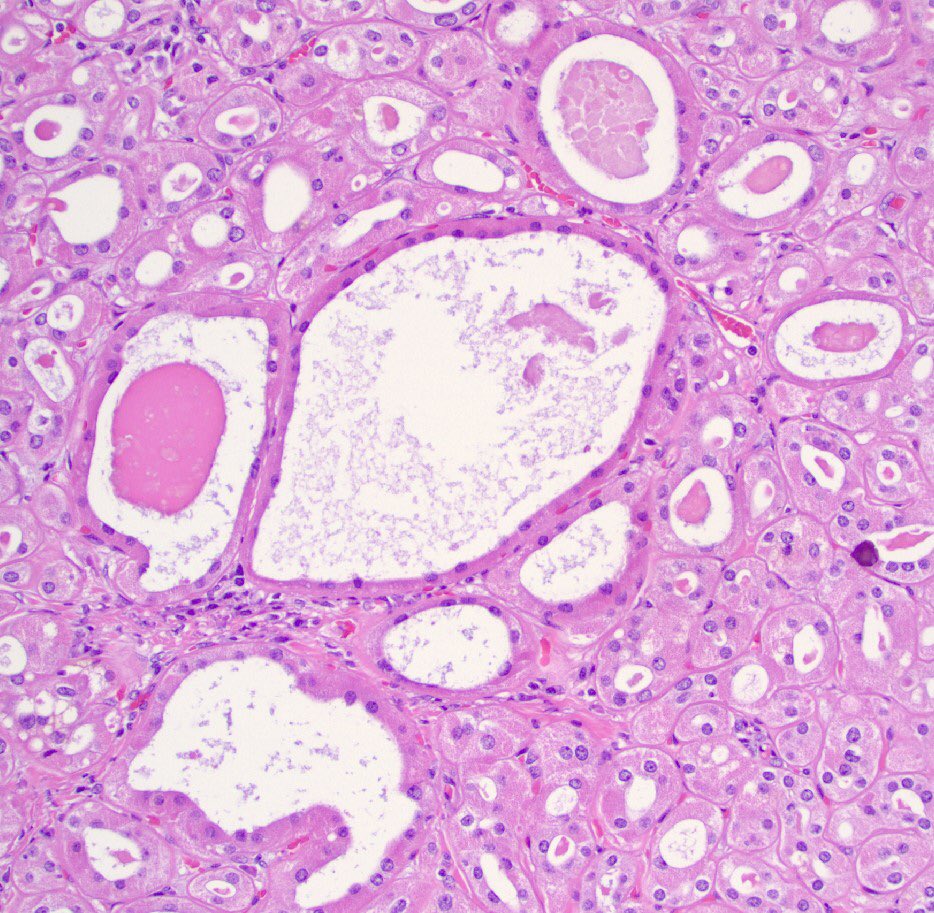 4.3 cm renal mass confined to kidney, tumor cells are predominantly with proliferative, tubular pattern 🎨 CK7 positive (strong, diffuse) 🎨 CD117 negative Thoughts? @Williamson_SR @Kiril_T_Can @MichelleDunno17 @priyaraomd @slusagar