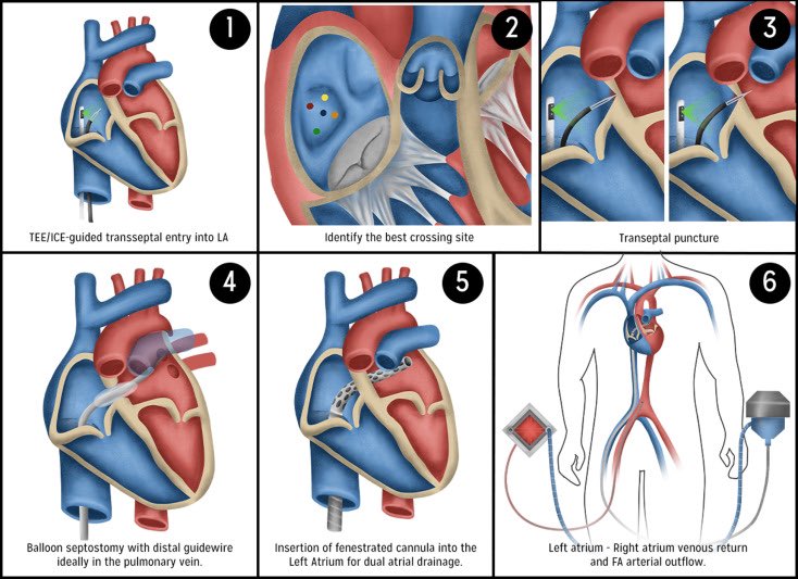 Left Atrial-Veno-Arterial (LAVA 🔥) Extracorporeal Membrane Oxygenation: Step-By-Step. @PedroMDMSc @Babar_Basir @BillONeillMD @preventfailure @KAlaswadMD @DeeDeeWangMD #ECMO #shock 📌doi.org/10.1016/j.shj.…