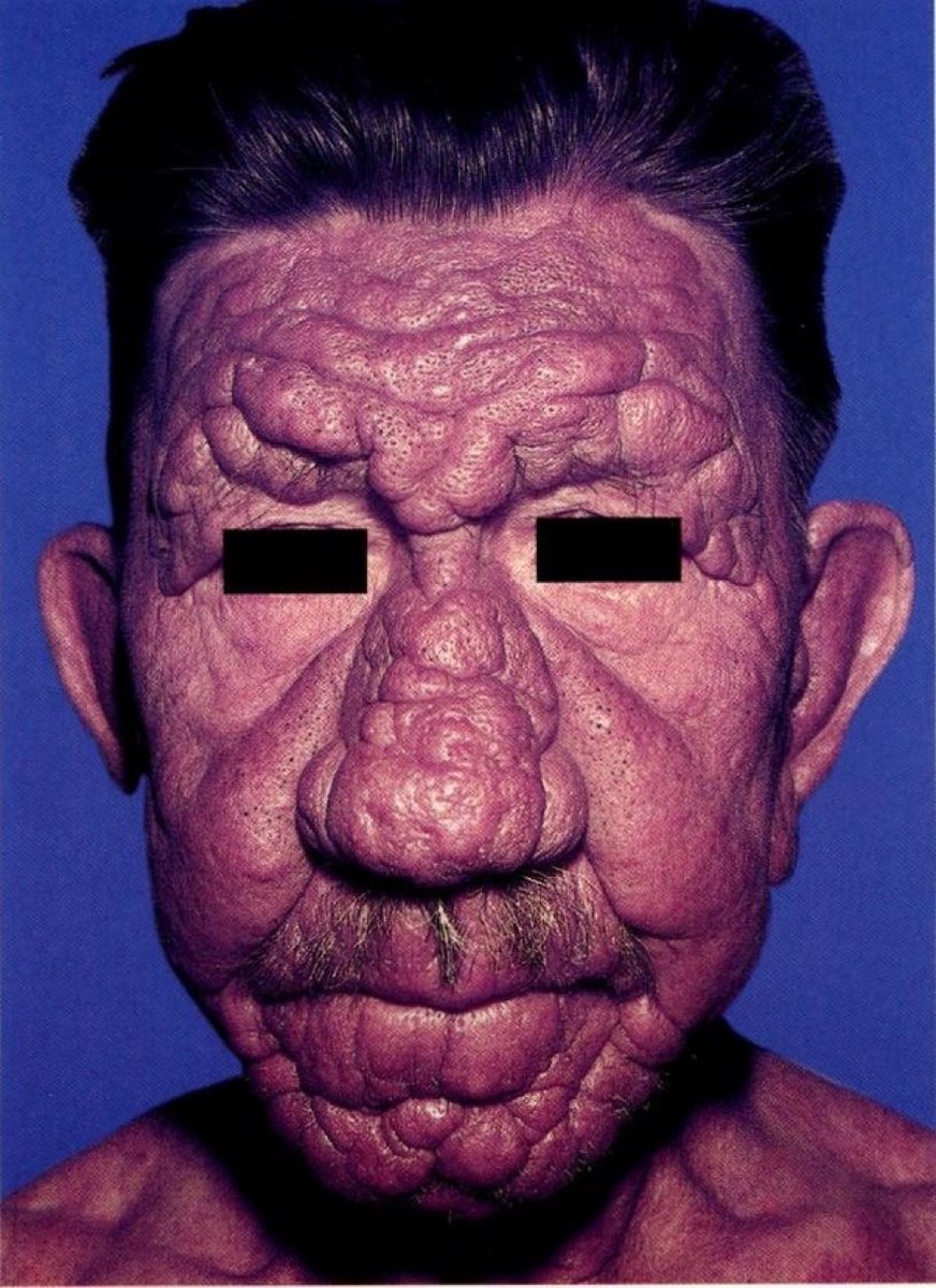 A 57-year-old man came with a 7-year hx of diffuse skin infiltration &amp; sensory loss in his left hand. His face had multiple nodular lesions that coalesced into plaques on the forehead, ears, nose &amp; lips. Skin smear showed AFB in clumps. What is the diagnosis? #Medtwitter