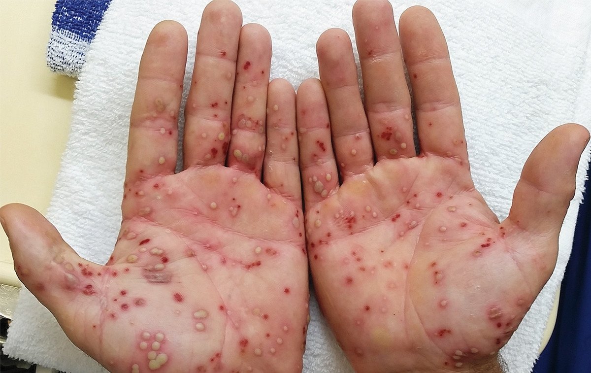 MoreXGrok's tweet photo. A 47-year-old man 

👉3-day history of a pustular rash that had developed on both hands https://t.co/JKv4KnXINJ