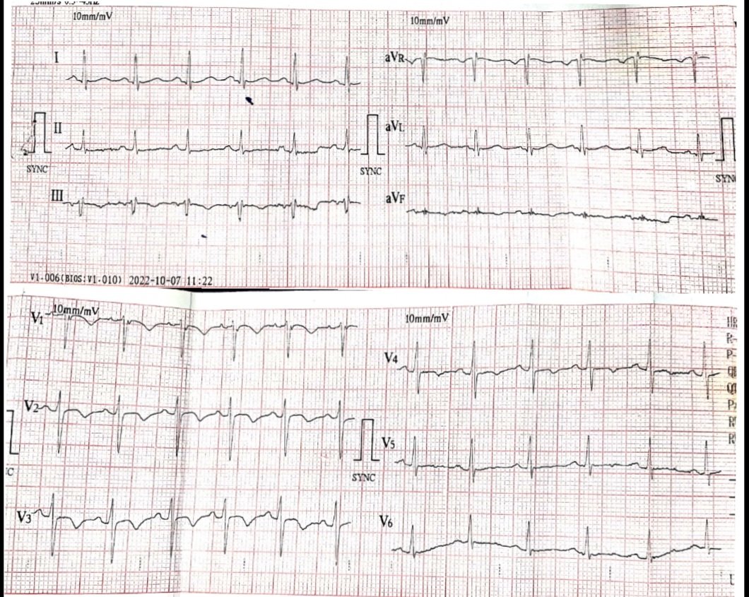 45 yr male school teacher , obese ,no co morbidities , with retrosternal chest pain and sweating in the morning . History of dizziness since three days . No LOC . Comments on ECG @syamkumarmd @DrRajeshG1 @ECG