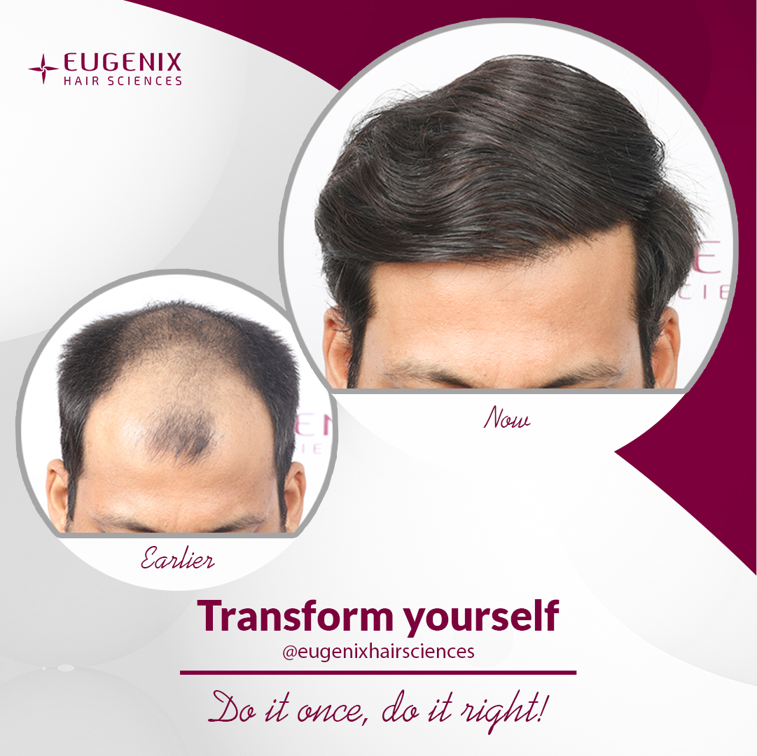 EugenixHair's tweet photo. Bring the required change in your looks with Eugenix Hair Sciences.

 #Change #ChangedLooks #Looks #NaturalHairTransplant #NaturalHairline #BestHairlineDesign #NaturalResults #HairTransplantResults #HairTransplantCost #HairTransplantClinic #BestHairClinic #hairtransplant #fue https://t.co/ikJ6NKuvFL