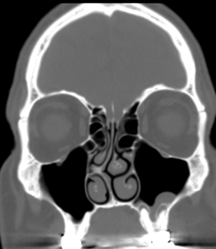 DrScottFortune's tweet photo. This is NOT #odontogenicsinusitis this is #periapicalabscess @JohnCraigNose @ent_ams https://t.co/yUC8QldMar