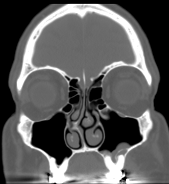DrScottFortune's tweet photo. This is NOT #odontogenicsinusitis this is #periapicalabscess @JohnCraigNose @ent_ams https://t.co/yUC8QldMar