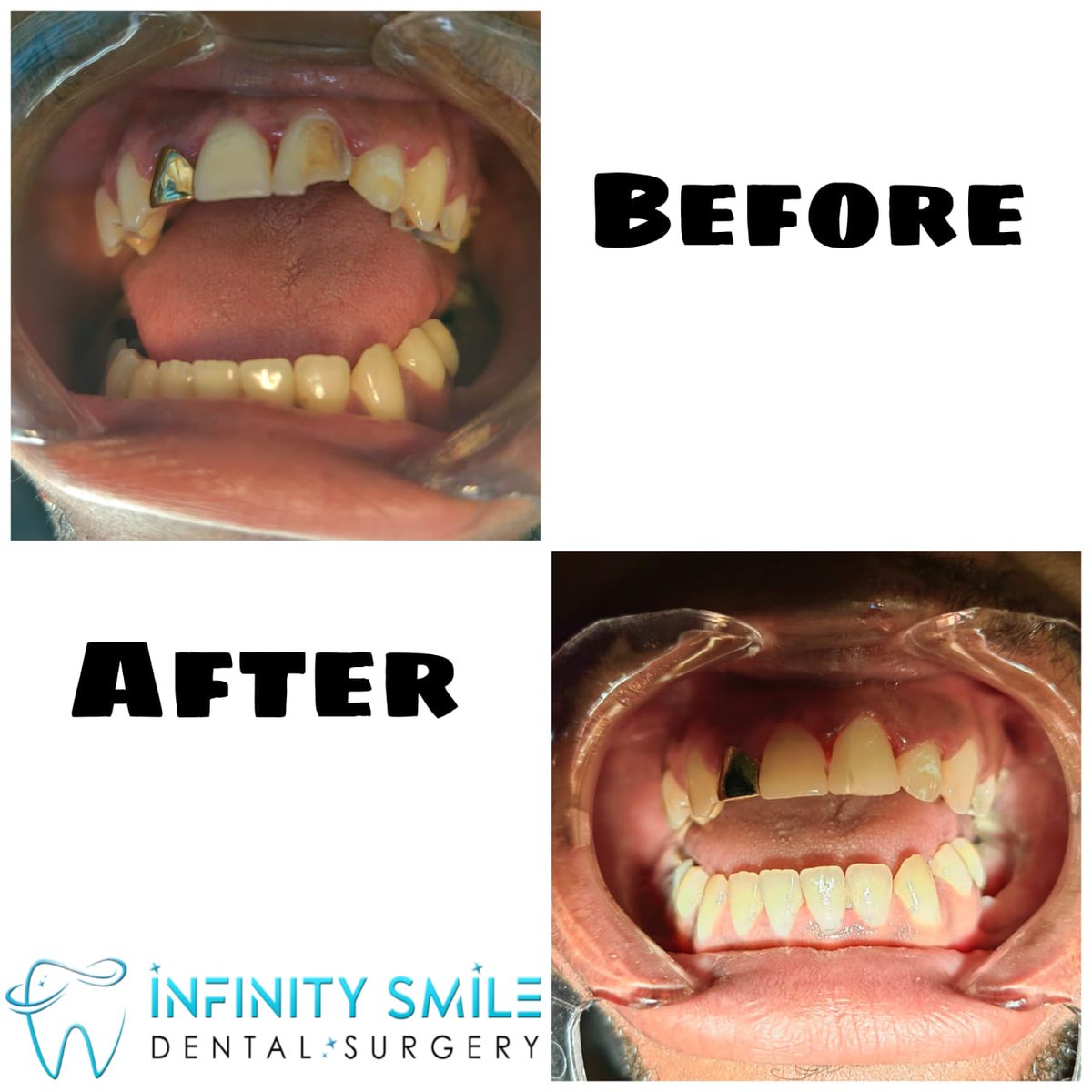 smile_surgery's tweet photo. Tooth Filling/Restoration 🦷 Happy Client!
--------------------
Let us help you bring your smile back 😁

DM/Whatsapp 0672925777 to book appointment

#toothfilling #toothrestoration #nopulpalinvolvement #fixingsmiles #dentalhealth #dentalcare #infinitysmiledentalsurgery https://t.co/zFJM2Zsa9c
