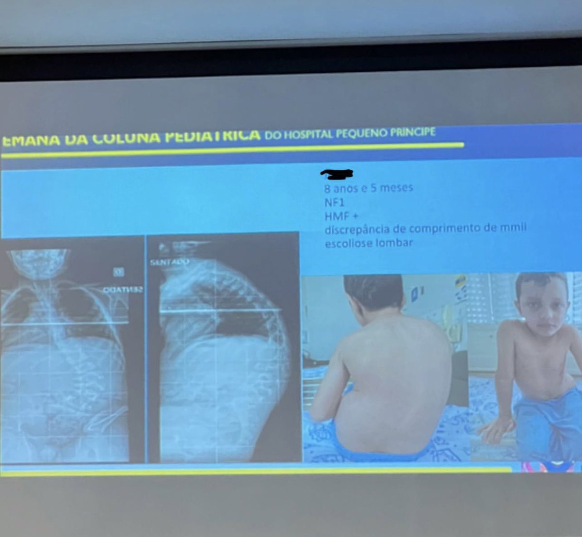 KiHwangMD's tweet photo. Check out Dr.Faloon’s Scoliosis mission trip to Brazil. A team of creatives and healthcare professionals have been working on a very unique mission trip for the last year and a half. #scoliosis #srs https://t.co/72UoCFAIM3