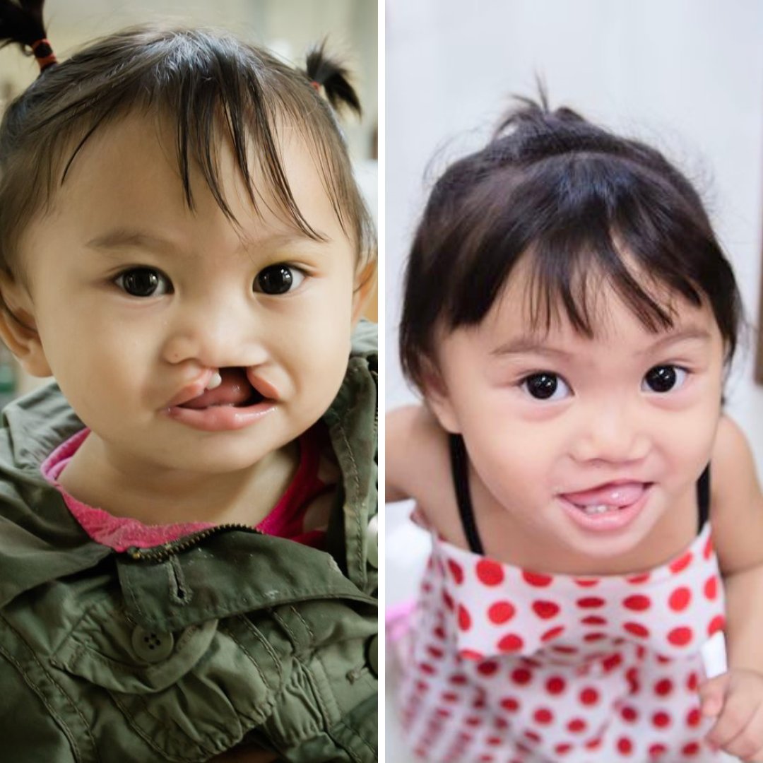 Andrea's family found out about @TebowCURE on social media and messaged us. “I thank God for bringing us here to #TebowCURE so that my daughter won't have to suffer anymore because of her condition,” her mom shared. @tebowfoundation @Smiletrain #SmileTrain #cleftlip