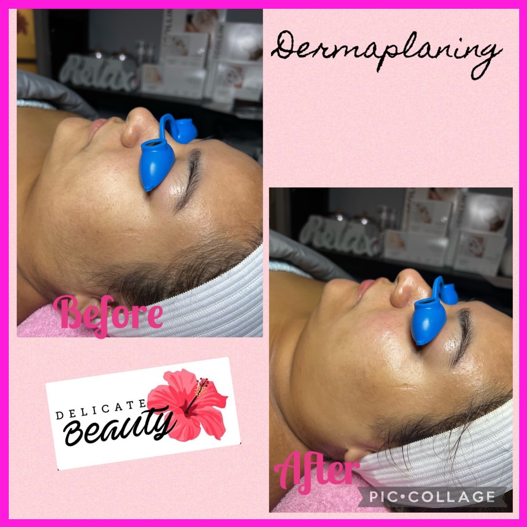 DelicateBeaut_'s tweet photo. Dermaplaning, unlike traditional shaving, uses a smaller blade to slough off dead skin cells in addition to removing wispy facial hair, so skin is more even in tone and texture.

#dermaplaning #skincarejunkie #NJesthetician #beauty #selfcare #njesthetics #njskincare #myskincare https://t.co/b3JeLptVRz