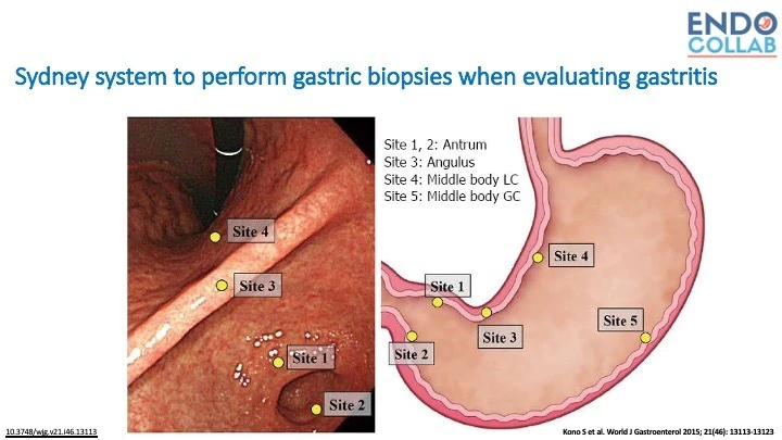 Tratamiento gastritis cronica atrofica