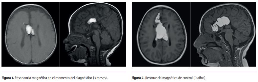 RevNeurol's tweet photo. 📬¡Nuevo artículo de Revista de Neurología! 

📖Crecimiento atípico en un lipoma intracraneal

📝@IISAragon
 
🔗https://t.co/wGfsT29LIq

#neurología #RevNeurol https://t.co/H15wIaAvkn