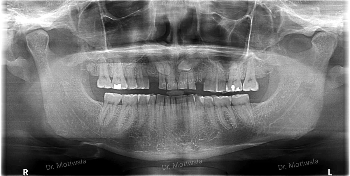 drmotiwaladcic's tweet image. The impacted canine was extracted and replaced with single-piece basal implants. 

#basalimplants #dentistry #zirconiacrowns #dentalimplants #missingfrontteeth #impactedcanines #extractions #singlepiece
#Hyderabad #India #australia #canada #newzealand 

drmotiwala.com/full-mouth-rec…