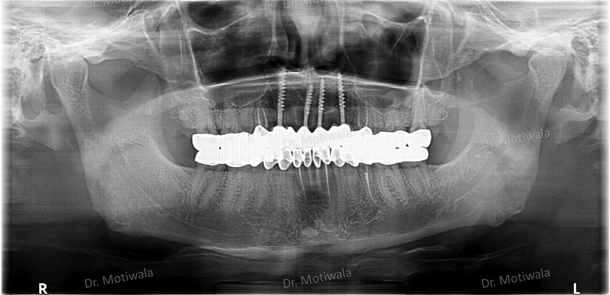 drmotiwaladcic's tweet image. The impacted canine was extracted and replaced with single-piece basal implants. 

#basalimplants #dentistry #zirconiacrowns #dentalimplants #missingfrontteeth #impactedcanines #extractions #singlepiece
#Hyderabad #India #australia #canada #newzealand 

drmotiwala.com/full-mouth-rec…