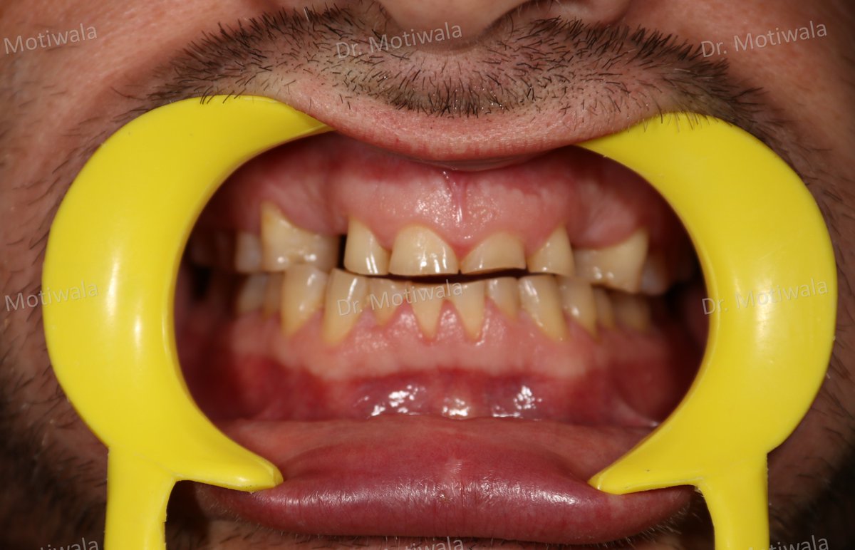 drmotiwaladcic's tweet image. The impacted canine was extracted and replaced with single-piece basal implants. 

#basalimplants #dentistry #zirconiacrowns #dentalimplants #missingfrontteeth #impactedcanines #extractions #singlepiece
#Hyderabad #India #australia #canada #newzealand 

drmotiwala.com/full-mouth-rec…