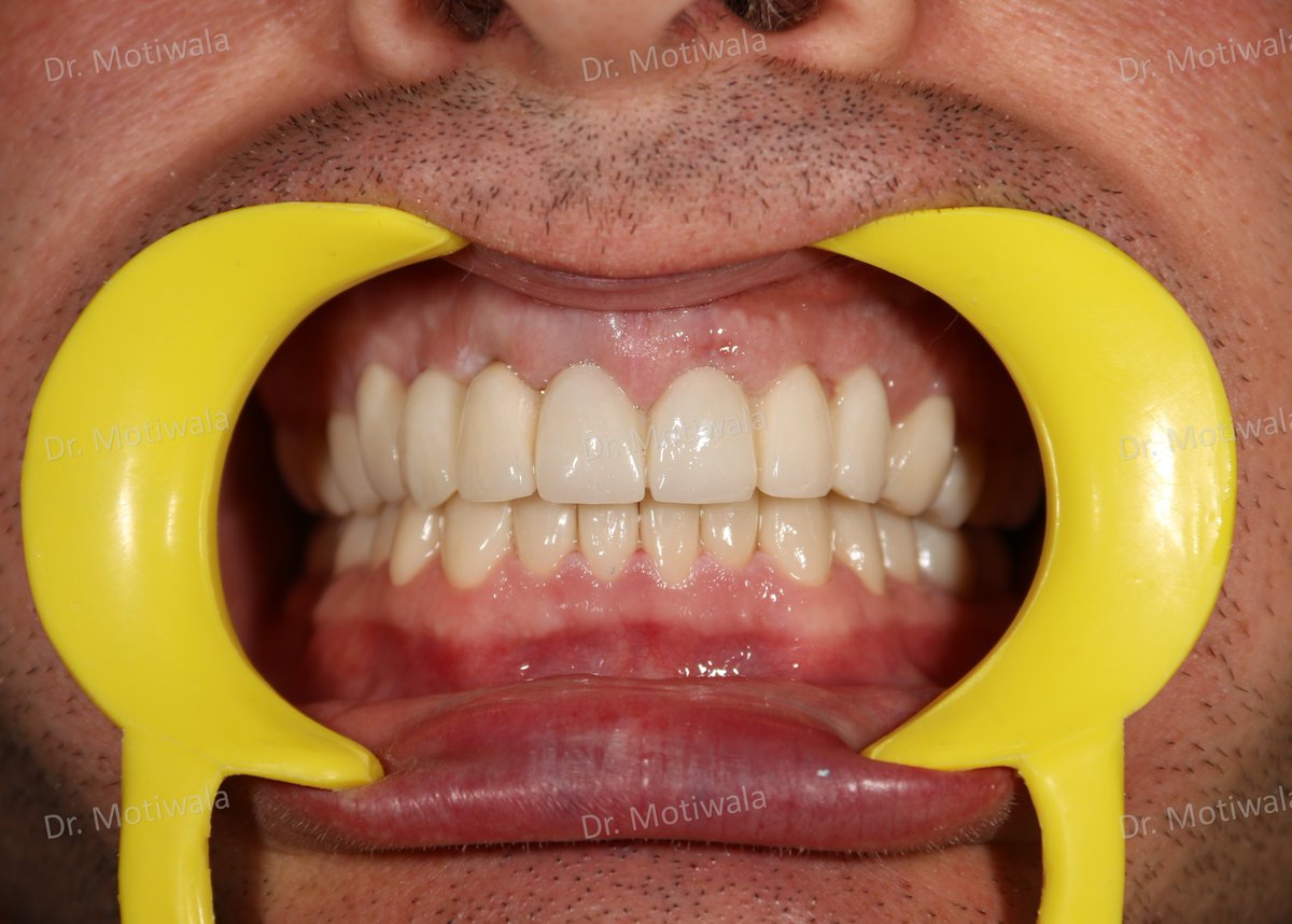 drmotiwaladcic's tweet image. The impacted canine was extracted and replaced with single-piece basal implants. 

#basalimplants #dentistry #zirconiacrowns #dentalimplants #missingfrontteeth #impactedcanines #extractions #singlepiece
#Hyderabad #India #australia #canada #newzealand 

drmotiwala.com/full-mouth-rec…