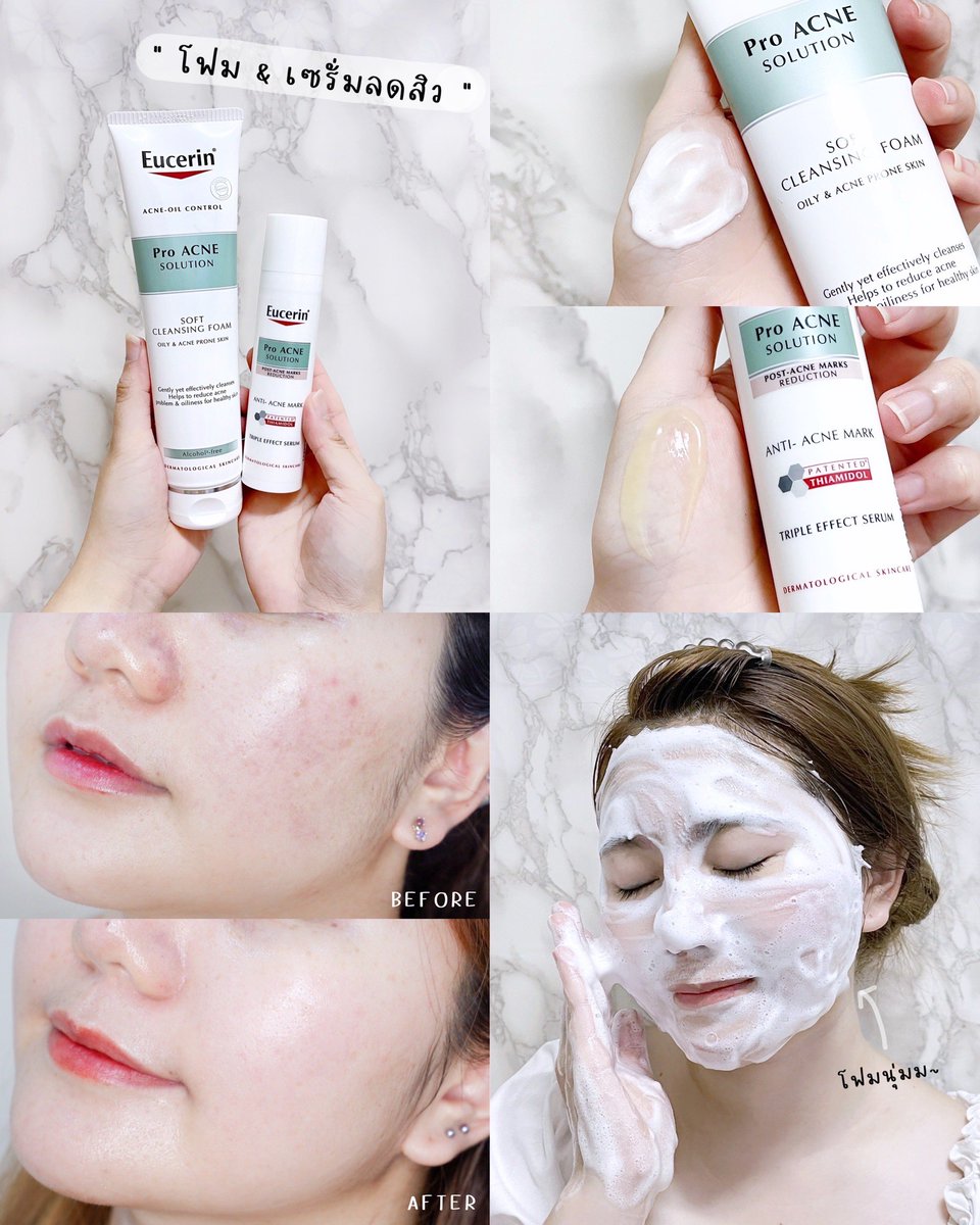 raymikky's tweet photo. เรื่องสิวยกให้ Eucerin เลยจริงๆ ใช้คู่นี้มาสักพักแล้วผิวดีขึ้นมาก เซรั่ม Anti Acne mark คือช่วยลดพวกสิวอุดตัน ลดรอยแดงได้ดีมาก เนื้อเซรั่มบางเบาซึมไว แนะนำให้ใช้คู่กับโฟมลดสิวตัวนี้ เห็นผลไวขึ้น ผิวดีขึ้นเยอะประทับใจมาก ใช้ดีจริง! พิกัด Watsons #EucerinThailand https://t.co/irZPx1sCvP