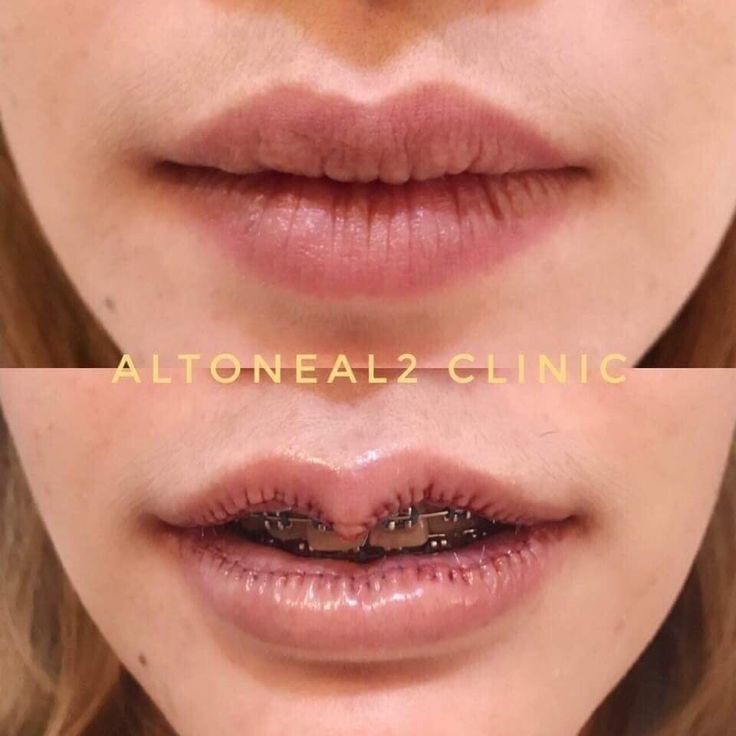 rostotona's tweet image. Algunos médicos cirujanos plásticos deberían hacer algún curso de motricidad orofacial y la importancia del sellado bilabial en la deglución.