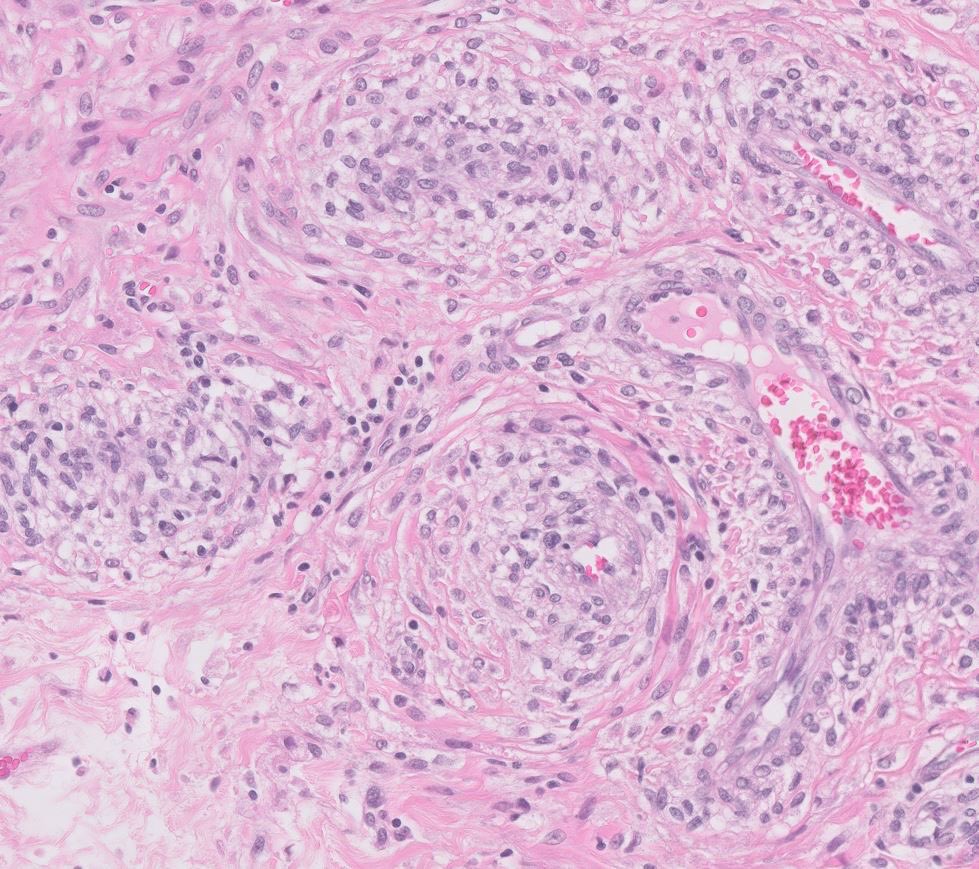 #Gynpath Uterine PEComa
🔹Perivascular epithelioid cell tumor
🔹Rare mesenchymal neoplasm with muscular and melanocytic differentiation
🔹Arises from perivascular epithelioid cells
🔹Intramural or polypoid mass
(1/3)