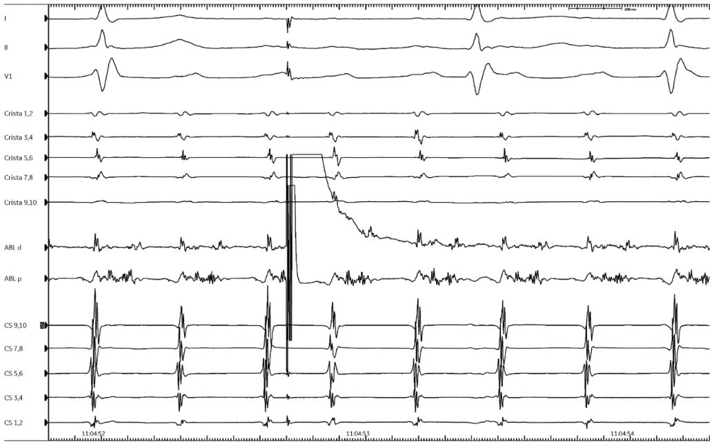 PennEPFellows's tweet photo. Recurrent atrial flutter in a patient with lung transplant. Amazing EGMS and maneuvers on LPV ridge.  (@CerantolaMaxime&amp;Dr Kumareswaran)

With progressively premature stimuli, there was resetting with concealed fusion followed by termination with non-propagated stimulus.
#EPeeps https://t.co/zTB7CqLeiL