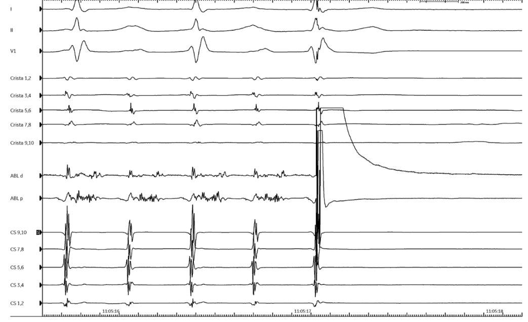 PennEPFellows's tweet photo. Recurrent atrial flutter in a patient with lung transplant. Amazing EGMS and maneuvers on LPV ridge.  (@CerantolaMaxime&amp;Dr Kumareswaran)

With progressively premature stimuli, there was resetting with concealed fusion followed by termination with non-propagated stimulus.
#EPeeps https://t.co/zTB7CqLeiL