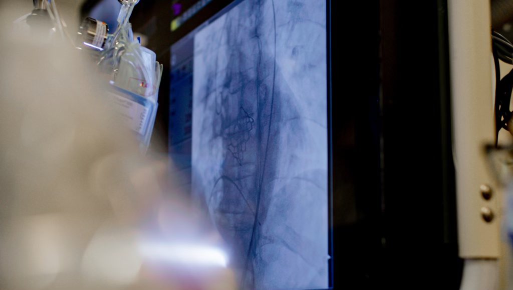 Proud to be the first institution to implant and offer the new <a href="/EdwardsLifesci/">Edwards Lifesciences</a> S3 Ultra #Resilia transcatheter aortic valve in the #tristatearea #tavr <a href="/ValleyHospital/">مستشفى الوادي الطبي valley medical hospital</a>