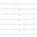 Photo by ECG Cases (@ecg_cases)