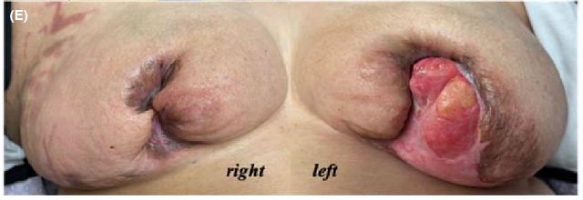 dr_sorenson's tweet photo. Terrible post-op pyoderma gangrenosum in a patient with history of COVID-19

https://t.co/Hk1uWCwLrm https://t.co/DLRiujlZGx