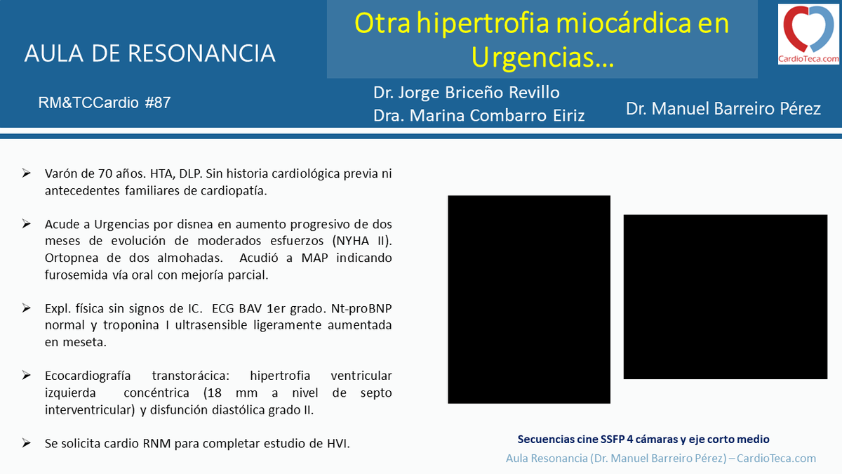 cardioteca's tweet photo. 📢 Otra hipertrofia miocárdica en Urgencias…

🧑🏻‍🔬 El Dr. Barreiro  @manuelbarreirop  y su equipo nos ponen a prueba en un nuevo caso #RMTCCardio 87 en el Aula de Resonancia.

👉 Míralo aquí: https://t.co/5Sz28jgvDB

#resonancia #tomografia #cardiologia https://t.co/cLjR9kfuwi