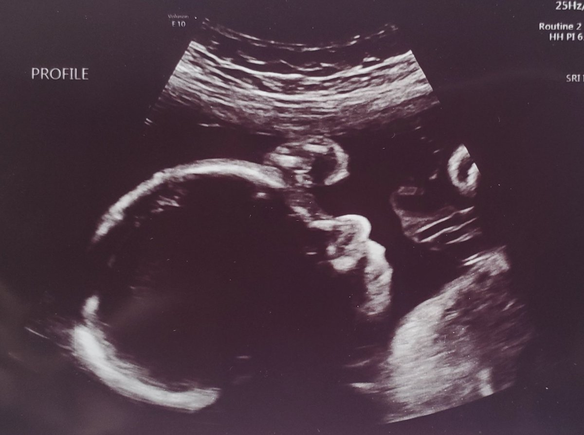NolaNikole's tweet photo. Cute baby @Michael_NKLW #ultrasound #profile_photo #35week https://t.co/JJH8eZ3oqo