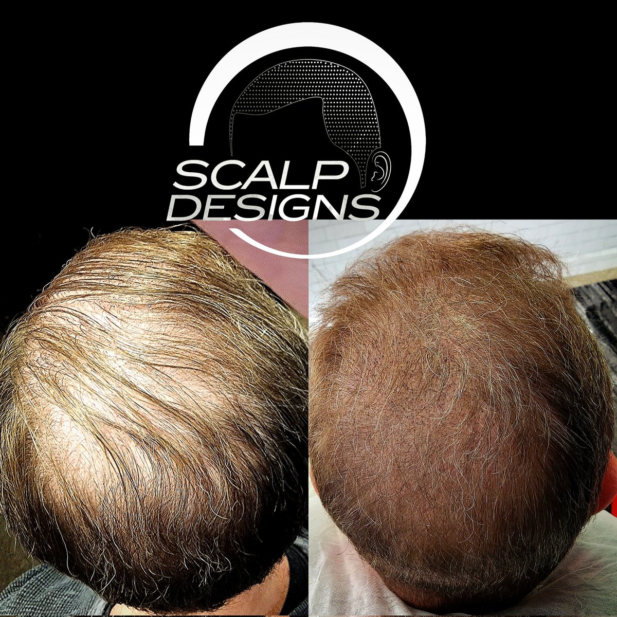 ScalpDesigns's tweet image. 1 Hair loss Solution for Men and Women Scalp Designs Innovative Non Invasive. Hair Loss Solution ✅️☑️✅️☑️✅️☑️ scalpdesigns.com 🔫🔫🔫🔫
 Free Consultation 📞 508-505-8106  #scalpmicropigmentation #scalppigmentation #hairthinning #thickerhair #hairtattoo #smp