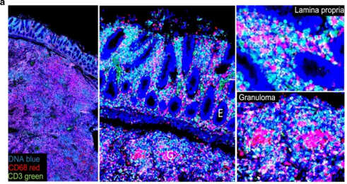 Hermansky-Pudlak syndrome causes Crohn’s disease-like inflammation, lung fibrosis, and macrophage lipid accumulation. Here researchers show dysregulated immunometabolism contributes to the impaired anti-microbial immunity and inflammation:
nature.com/articles/s4138…
