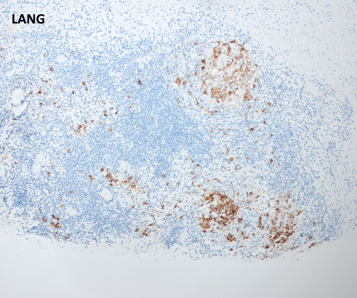 DrJPLow's tweet photo. My initial thoughts were something granulomatous... but with an odd number of eosinophils. Which prompted me to do these immunohistochemistry stains. 
#haempath vs #pedipath vs #neuropath 😊I'm glad we're general in Australia! https://t.co/DTH6hsD9SL