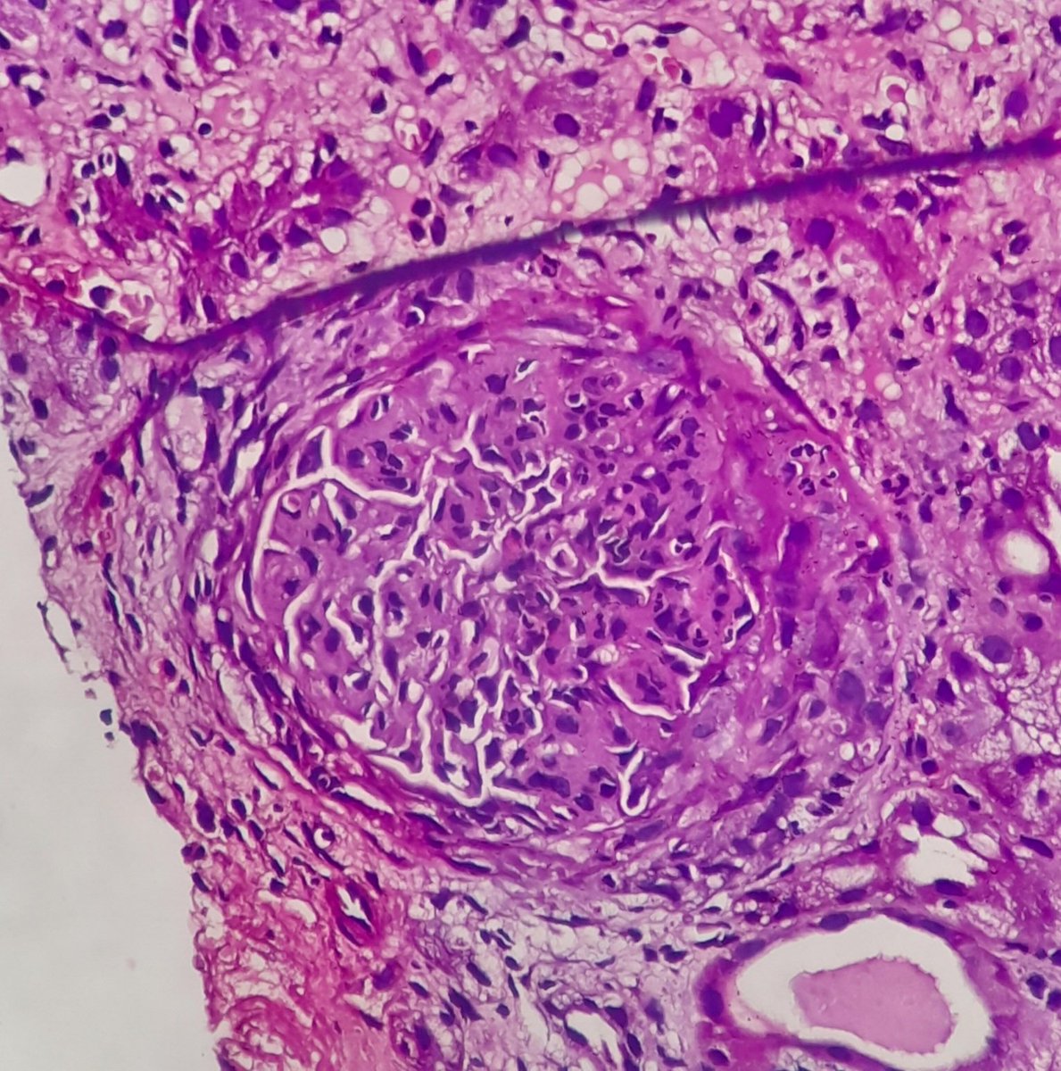Archana bhat (@archibhat3) on Twitter photo 50 year old man presented with nephritic syndrome #APCON2022 #APCON2022PathTweet #renalpath #PathTwitter #pathspotter #NephTwitter #histopath #pathology <a href="/pembeoltulu/">Pembe Oltulu, MD</a> <a href="/VHNguyenMD/">Van-Hung Nguyen MD 🇺🇦🌻</a> <a href="/DrFouzia8/">Jay</a> <a href="/smlungpathguy/">Sanjay Mukhopadhyay</a> <a href="/drmjkulkarni/">Manjunath Kulkarni 🇮🇳</a> <a href="/LangoteAmit/">Amit Langote</a> <a href="/premcharles/">Prem Charles</a> <a href="/pepeheffernan/">Pepe Jiménez Heffernan</a> <a href="/rdpatho/">rajEndiran</a> <a href="/VijayPatho/">Vijay Shankar S</a> 50 year old man presented with nephritic syndrome #APCON2022 #APCON2022PathTweet #renalpath #PathTwitter #pathspotter #NephTwitter #histopath #pathology <a href="/pembeoltulu/">Pembe Oltulu, MD</a> <a href="/VHNguyenMD/">Van-Hung Nguyen MD 🇺🇦🌻</a> <a href="/DrFouzia8/">Jay</a> <a href="/smlungpathguy/">Sanjay Mukhopadhyay</a> <a href="/drmjkulkarni/">Manjunath Kulkarni 🇮🇳</a> <a href="/LangoteAmit/">Amit Langote</a> <a href="/premcharles/">Prem Charles</a> <a href="/pepeheffernan/">Pepe Jiménez Heffernan</a> <a href="/rdpatho/">rajEndiran</a> <a href="/VijayPatho/">Vijay Shankar S</a>