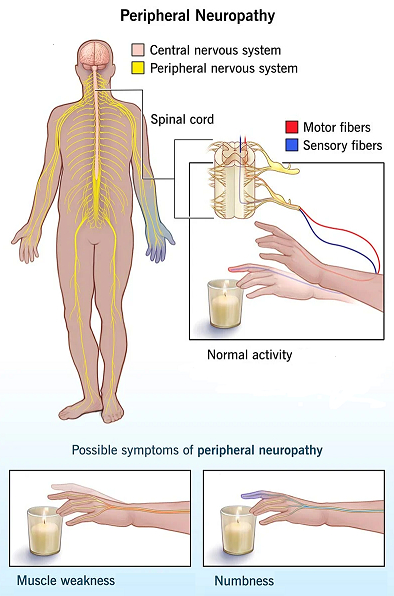 Janesthsurgres's tweet photo. Peripheral nerves link brain and spinal cord to other parts of body. Peripheral nerve surgery is used to improve function, minimize pain and disability in people with peripheral nerve disorders, like acute nerve injuries, entrapment neuropathies and nerve sheath tumors. 
#surgery https://t.co/8NVAd52dFt