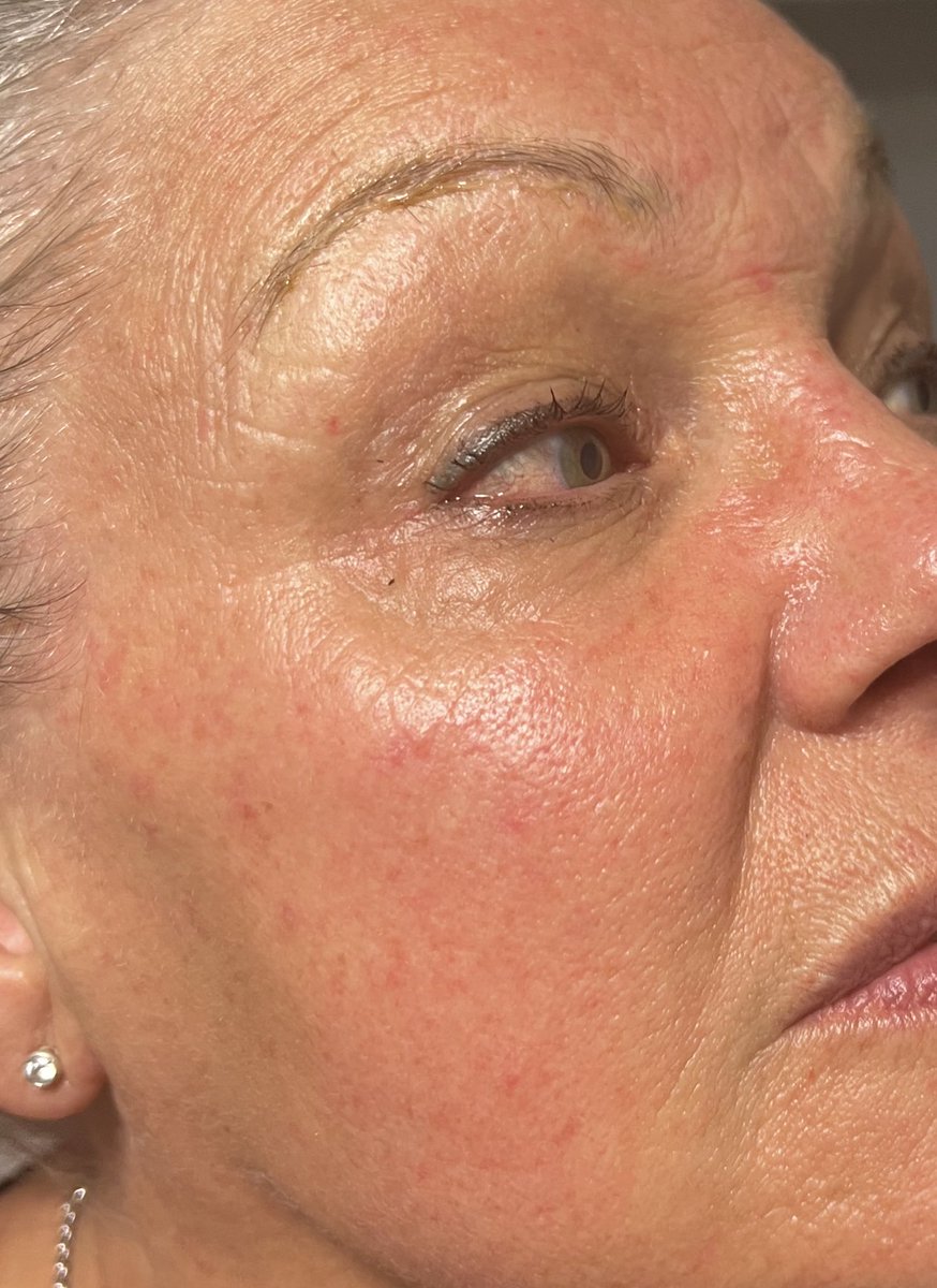 heavenskincare's tweet photo. This is lipolis 7 it’s a fantastic anti-aging treatment that takes less then half an hour ! @Salon_Heaven https://t.co/2G8XKFvAzP