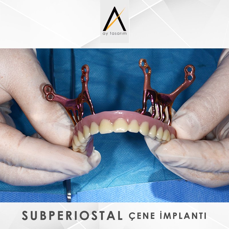 aytasarim's tweet photo. ⭕️Ay Tasarım, AMSJI ile hem maksilla hem de mandibula için kişiye özel 3D yazıcı ile üretilmiş subperiosteal titanyum implantlar sağlamaktadır. Bu konsept ileri düzey atrofik çeneye sahip hastalara yüksek standartlı bir çözüm. https://t.co/aoxKjdcJm7