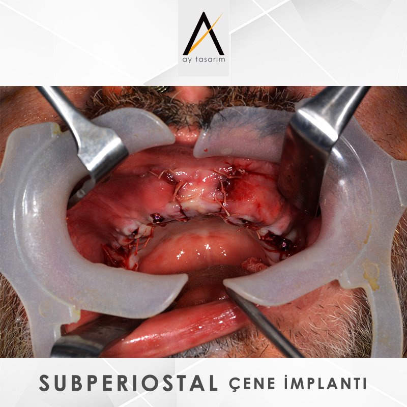 aytasarim's tweet photo. ⭕️Ay Tasarım, AMSJI ile hem maksilla hem de mandibula için kişiye özel 3D yazıcı ile üretilmiş subperiosteal titanyum implantlar sağlamaktadır. Bu konsept ileri düzey atrofik çeneye sahip hastalara yüksek standartlı bir çözüm. https://t.co/aoxKjdcJm7