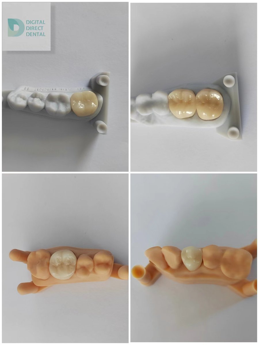 digitdirectdent's tweet photo. Full Strength Zirconia restorations use monolithic ultra high strength zirconia and offer durability of a gold crown with esthetics nearing porcelain, this is idea especially for posterior cases.👏😁 #monolithic #monolithiczirconia #Esthetics #dentallab #BRUXZIR https://t.co/I4xroyW4ES