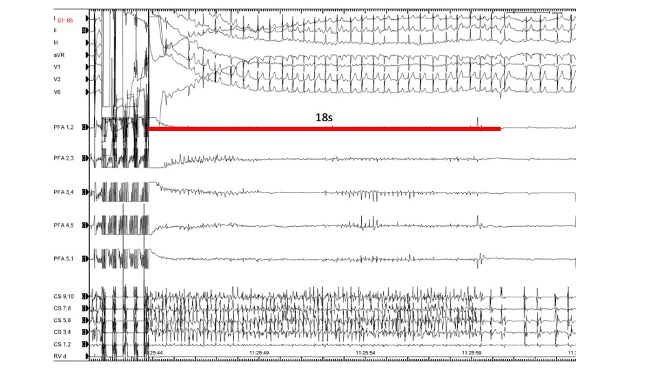 Philipp Sommer (@phiso_de) on Twitter photo 1 year of PFA <a href="/HdzNrw/">HDZ NRW</a>: still fascinated by the power of this energy source. Young patient, in AF since 3 weeks, 18s after completion of the 32 lesions converted to SR. <45min proc. time, incl. 3D mapping with voltage assessment. <a href="/AbbottCardio/">Abbott Cardiovascular</a> <a href="/BSCCardiology/">BostonSci Cardiology</a> @farapulse <a href="/AGEP_DGK/">AGEP</a> 1 year of PFA <a href="/HdzNrw/">HDZ NRW</a>: still fascinated by the power of this energy source. Young patient, in AF since 3 weeks, 18s after completion of the 32 lesions converted to SR. <45min proc. time, incl. 3D mapping with voltage assessment. <a href="/AbbottCardio/">Abbott Cardiovascular</a> <a href="/BSCCardiology/">BostonSci Cardiology</a> @farapulse <a href="/AGEP_DGK/">AGEP</a>