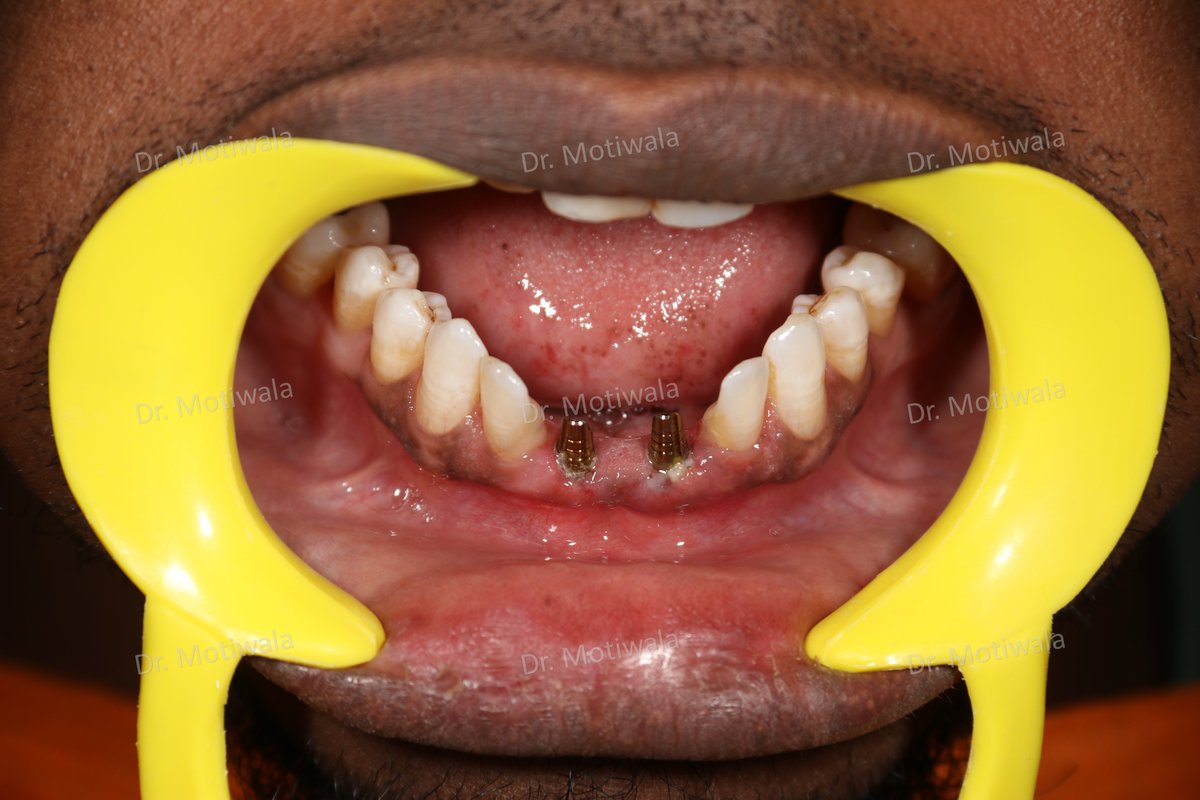 drmotiwaladcic's tweet image. Replacement of Missing Anterior Teeth 

Before and after pictures of lower missing teeth replaced with basal implants 

#basalimplants #dentistry #missingfrontteeth #zirconiacrowns #cosmeticdentistry #fixedteeth #missingteeth 

#Hyderabad #India  #australia #Canada #Mexico #USA