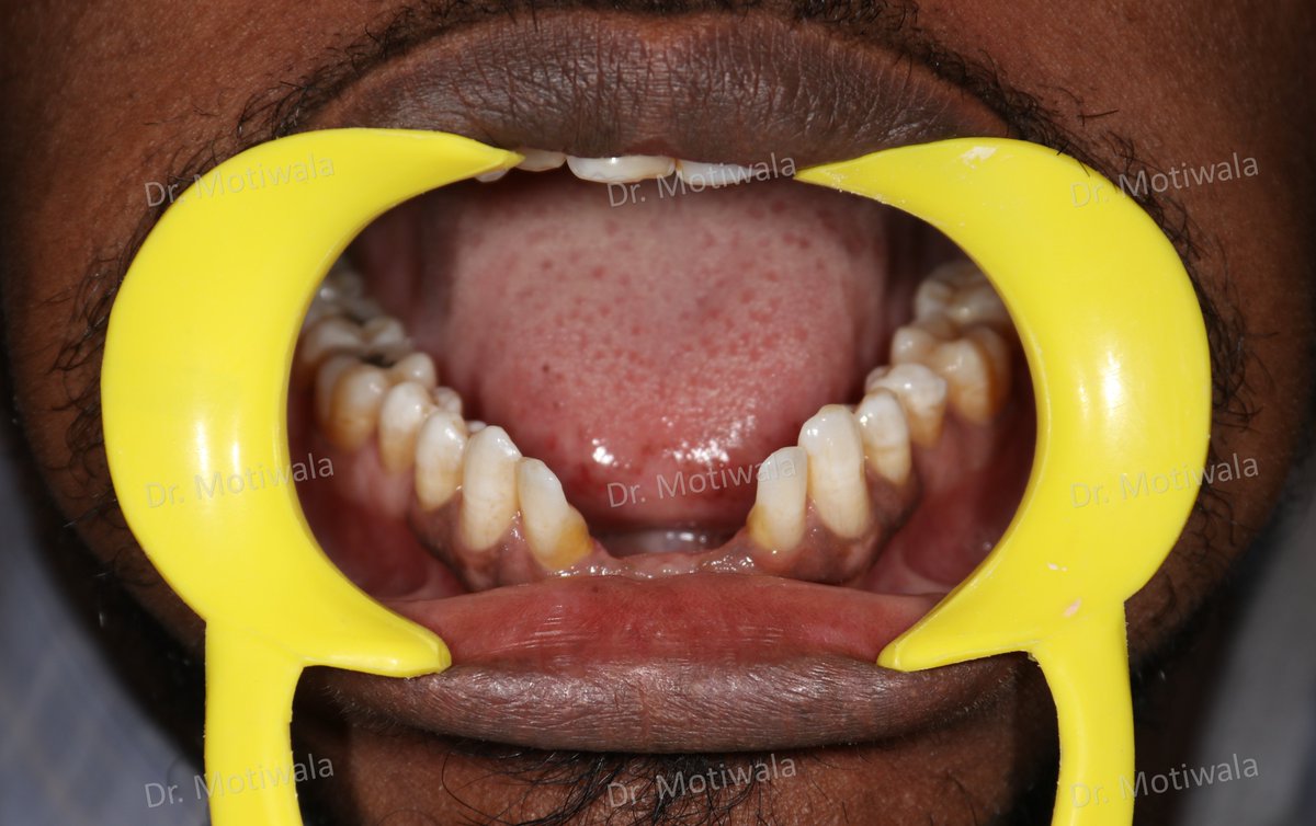 drmotiwaladcic's tweet image. Replacement of Missing Anterior Teeth 

Before and after pictures of lower missing teeth replaced with basal implants 

#basalimplants #dentistry #missingfrontteeth #zirconiacrowns #cosmeticdentistry #fixedteeth #missingteeth 

#Hyderabad #India  #australia #Canada #Mexico #USA