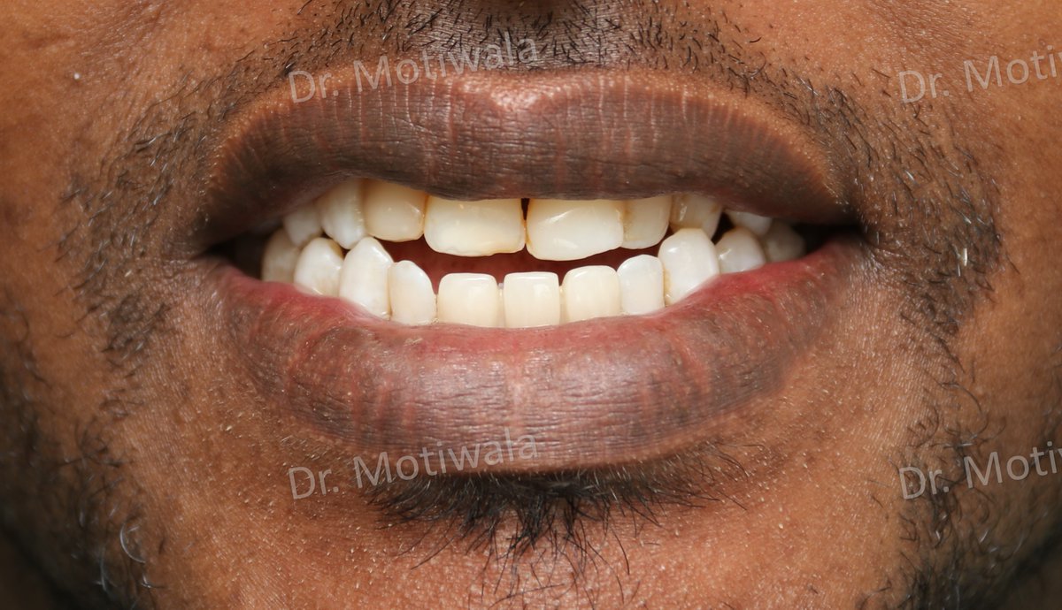 drmotiwaladcic's tweet image. Replacement of Missing Anterior Teeth 

Before and after pictures of lower missing teeth replaced with basal implants 

#basalimplants #dentistry #missingfrontteeth #zirconiacrowns #cosmeticdentistry #fixedteeth #missingteeth 

#Hyderabad #India  #australia #Canada #Mexico #USA