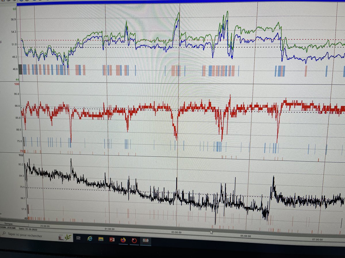 Copd patient with Paco2 at 50mm d’hg during the day….would you ventilate this patient? A polysomnography would ve very usefull but as the delay is 3 months….we are going to ventilate him…that’s real life…and that’s probably why copd is the first pathology ventilated at home