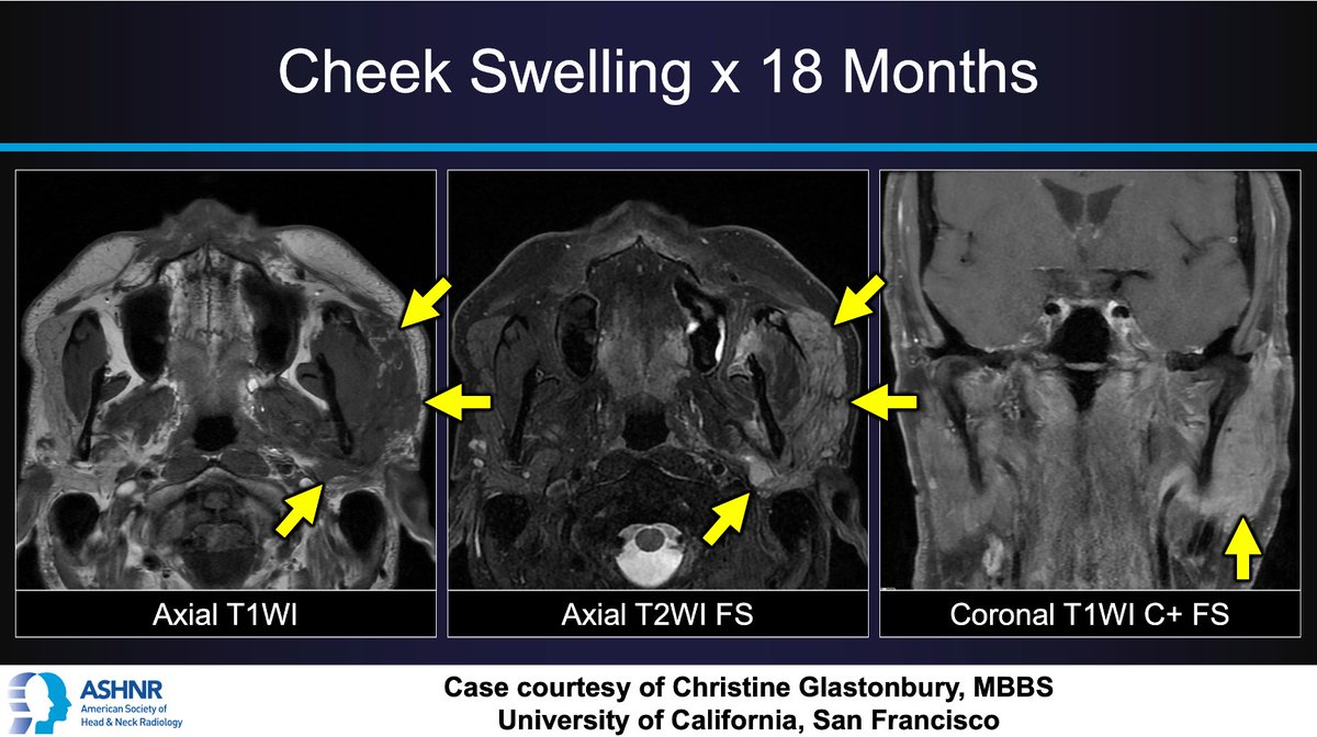 ASHNRSociety's tweet image. #ASHNRCOTW #206 ANSWER: Parotid (&amp;amp; masticator) lymphoma! Thx Dr. @CMGlastonbury 4 case! #ASHNR23

@AshokSrini15 @nancyfstanford @callyrobs @DShatzkes @CDP_Rad @rhwiggins @nakoontz @cmtomblinson @WmOBrienDO @tabby_kennedy @PhilipRChapman1 @CynXinWu @AnnJayMD1 @ESHNRSociety
