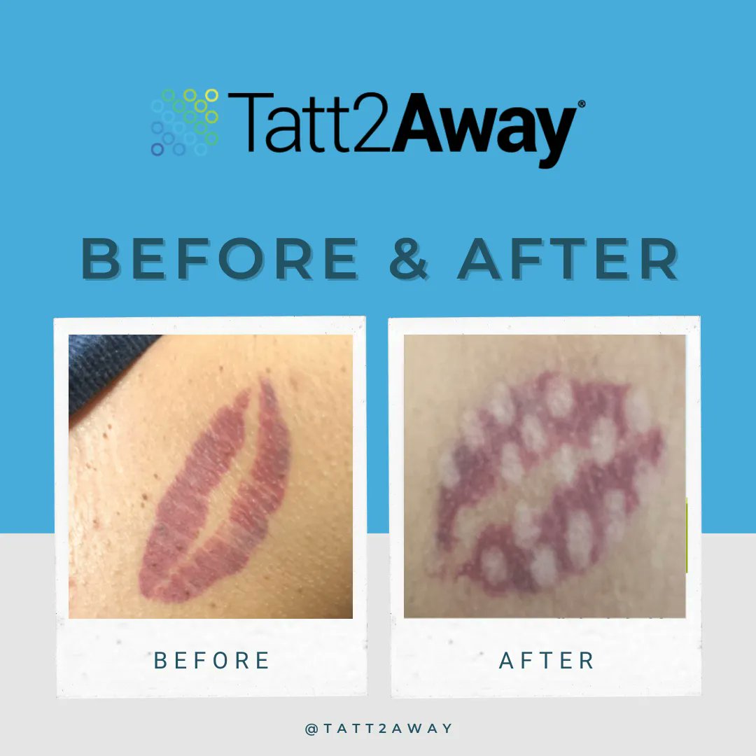 Tatt2Away's tweet photo. Colored ink is no match for Tatt2Away! Here are some results one of our clients had after just one session using our natural tattoo removal method. For more information about how Tatt2Away works, visit our website: https://t.co/DmP6Lxb5Av 💛 https://t.co/rxmCr0oxfV